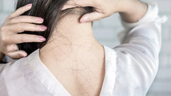 Causes courantes de perte de cheveux